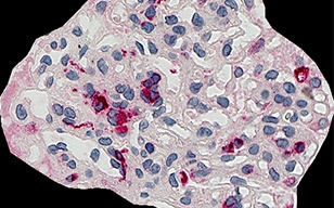 CD68（巨噬細(xì)胞）的腎小球占比自動分析